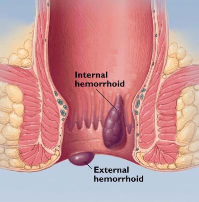 Piles Treatment in Nashik