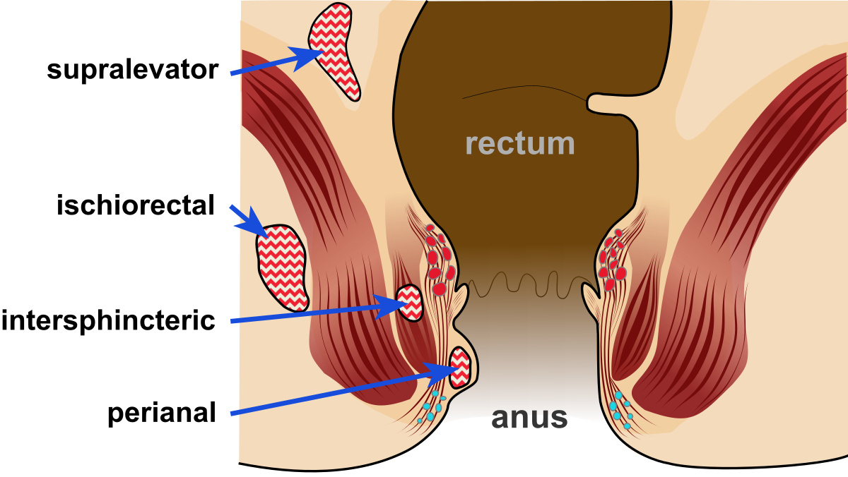 Fistula Treatment in Nashik