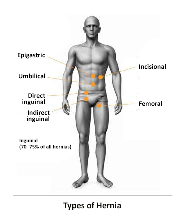 Hearnia Treatment in Nashik